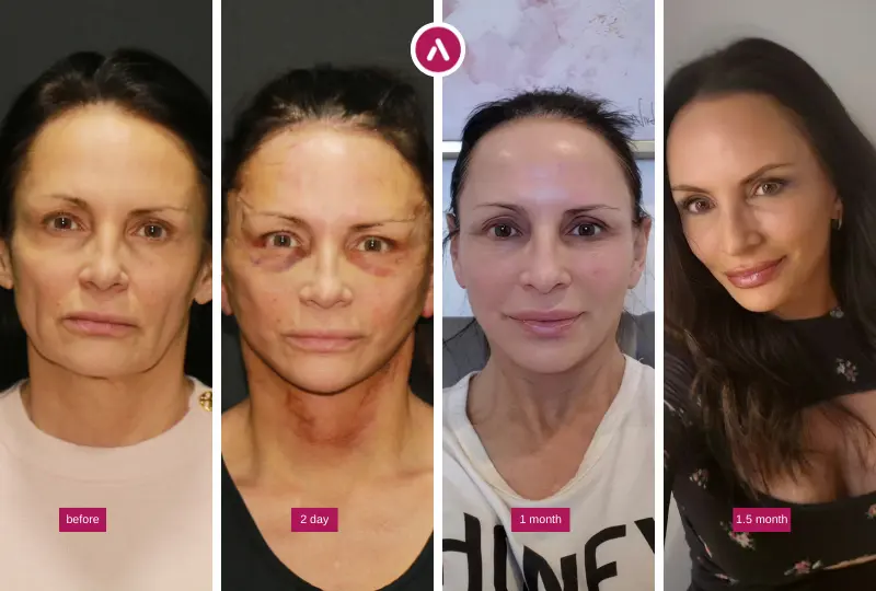 Deep Plane Facelift Recovery Day By Day Photos showing before, day 2 swelling/bruising, 1 month healing, and 1.5 month refined results.